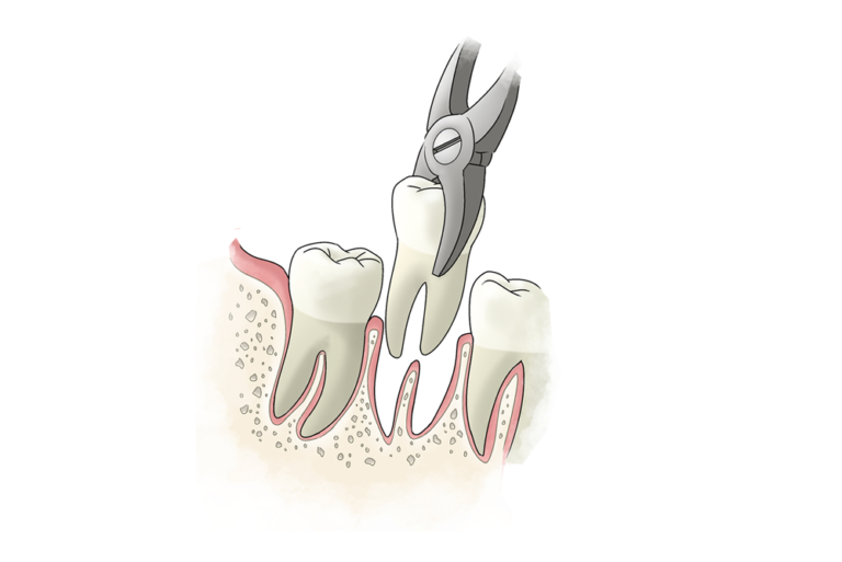 Об удалении зубов