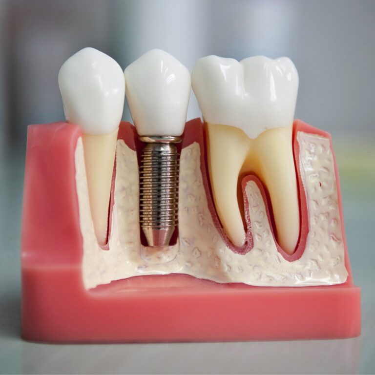 Имплантация зубов в Истре