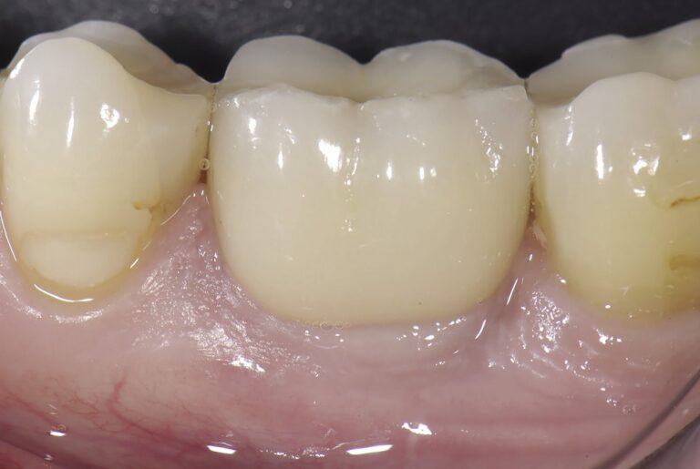 Концепция «Экструзии после удаления зуба» доктора Штефана Ноймайера