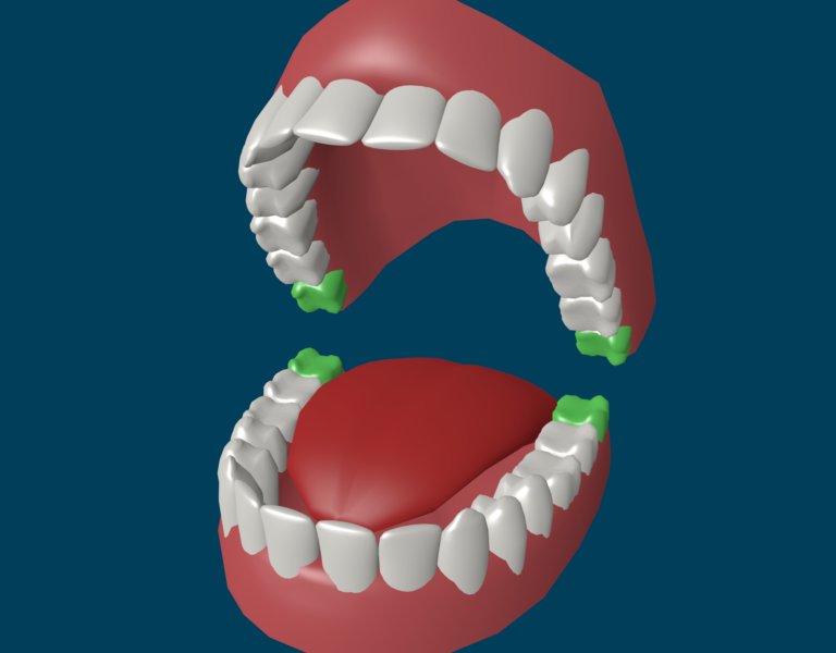 Зубы мудрости — что за зубы?