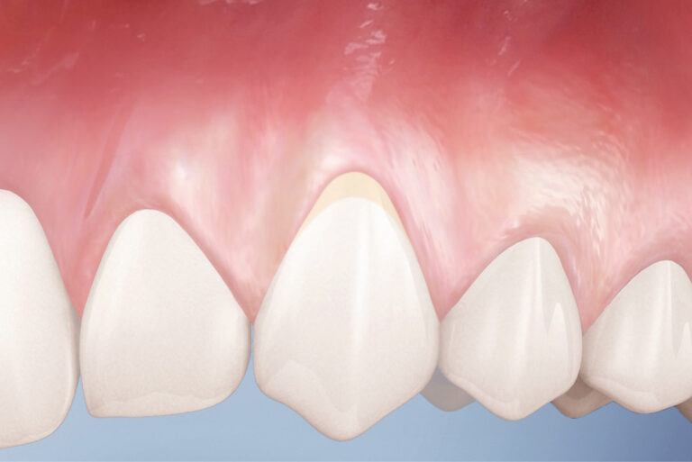 Болезнь зуба: Клиновидный дефект