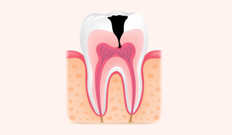 Болезнь зуба: Пульпит