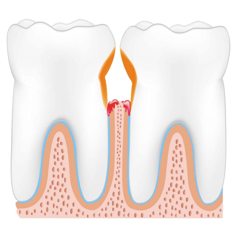 Болезнь зубов: Пародонтит