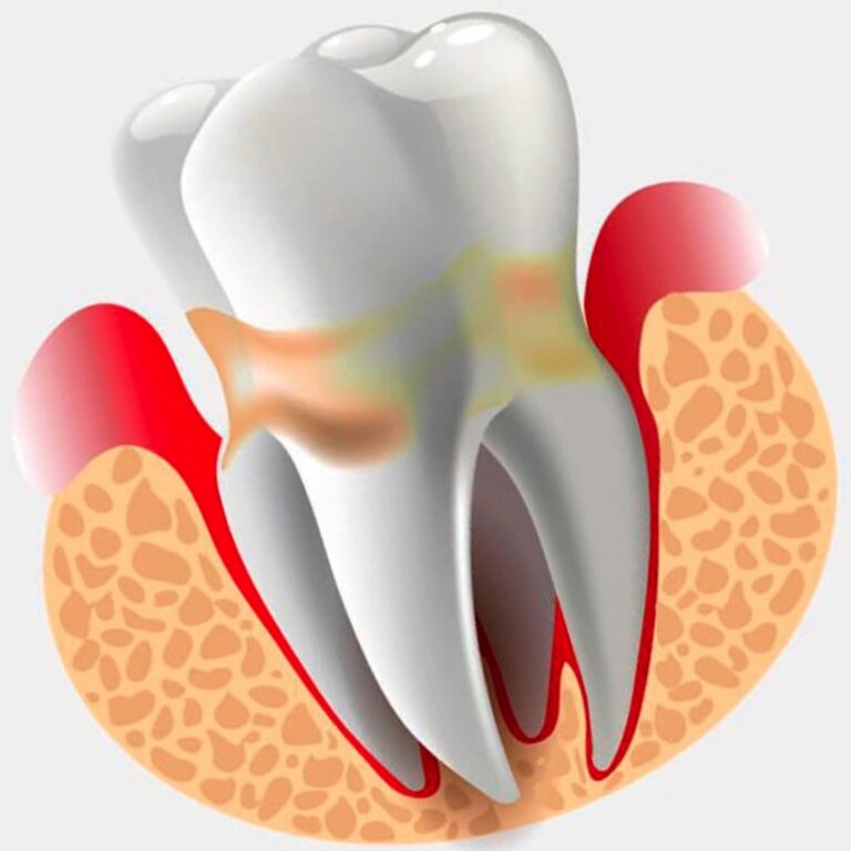 Болезнь зуба: Периодонтит