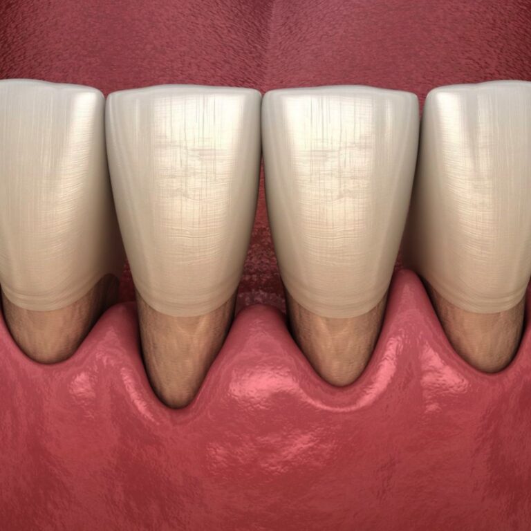 Болезнь зубов: Пародонтоз