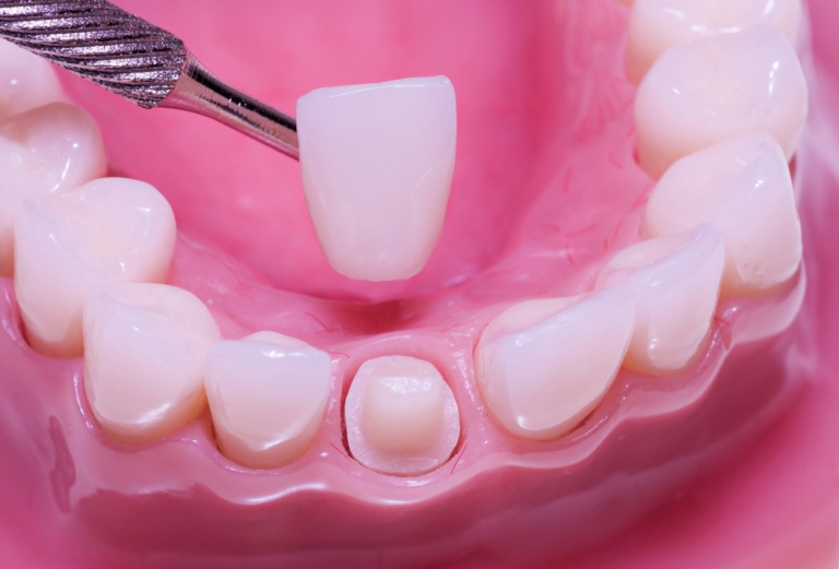 Процедура: Протезирование зуба (установка коронки) — от 9000 руб.