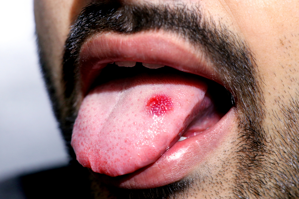Sintomas cancer de lengua fotos
