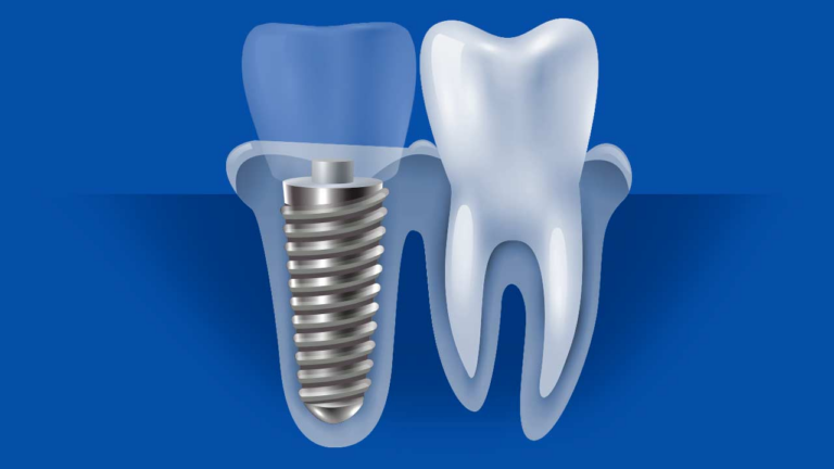 Имплантация зубов — подробно о процедуре и противопоказаниях