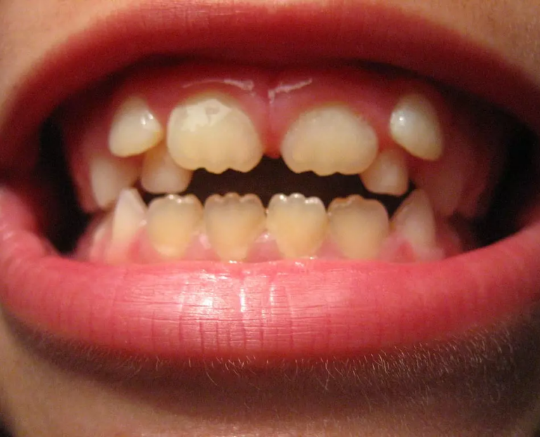 Классификация аномалий отдельных зубов