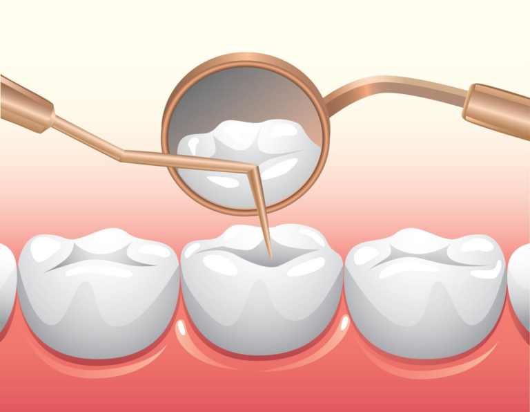 Какие бывают зубные пломбы?