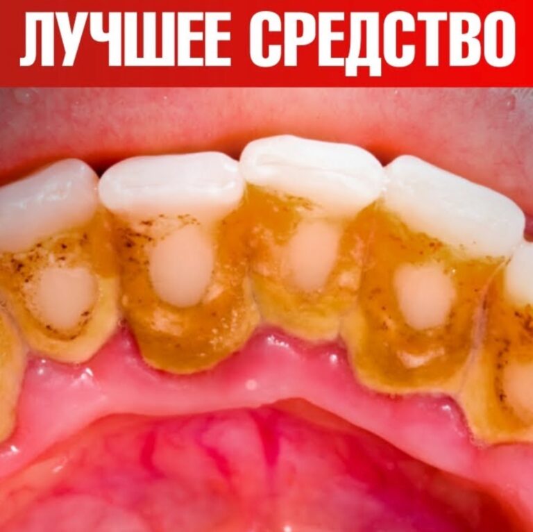 Зубной налет и зубной камень? Лучшее средство! — Dr. Berg