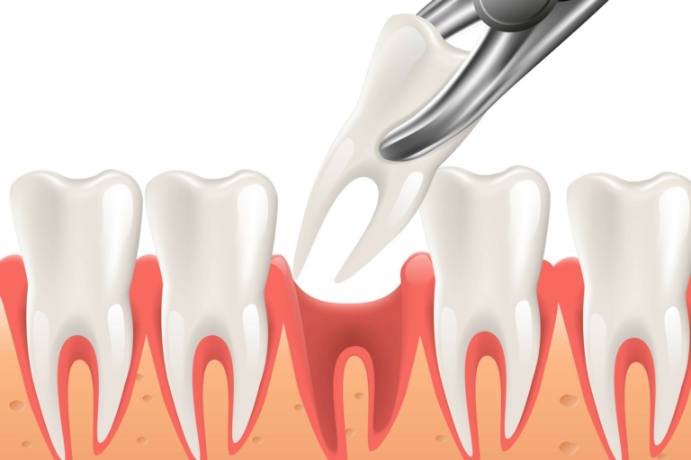 5 проблем, которые возникают вследствии удаления зубов