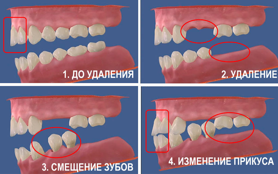 Последствия отсутствия зуба. Удаленное осложнение