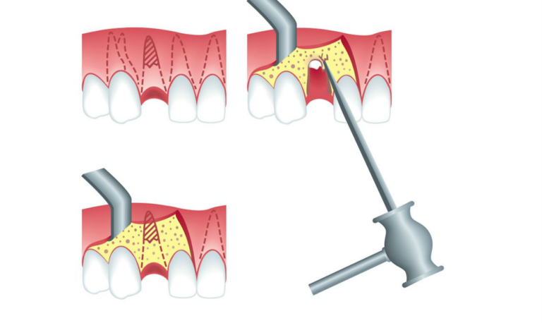 Стоматологический справочник: Ампутация корня зуба