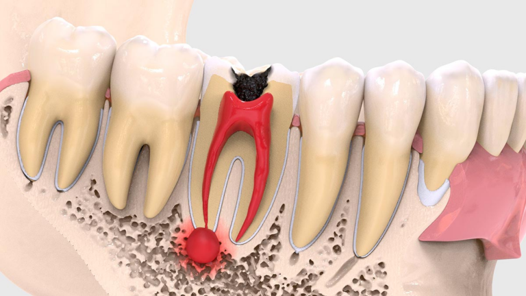 Гранулёма и киста зуба — что это такое?