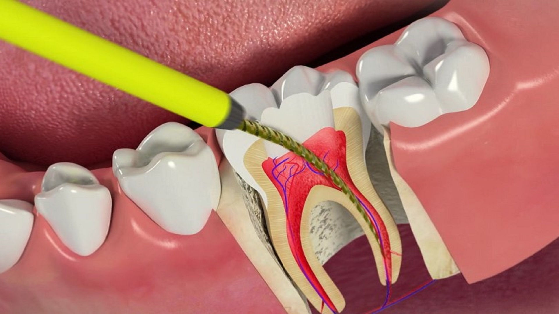 Десен системы. Пульпит 2 канального зуба. Пульпита (депульпирование зуба.