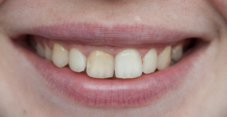 Болезни зубов у человека: Патологии эмали