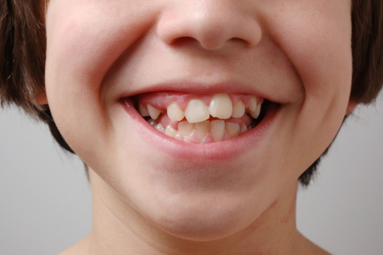 Болезни зубов у человека: Патологии прорезывания и формирования зубов